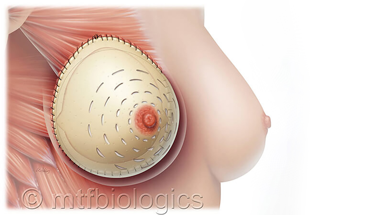 Advances in Implant Reconstruction - Prepectoral breast reconstruction