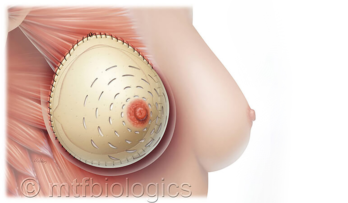 Prepectoral breast reconstruction with complete anterior implant